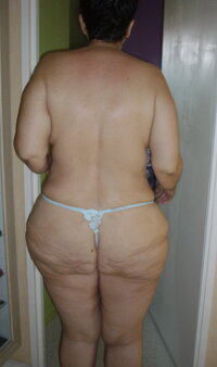 cellulite (3).jpg